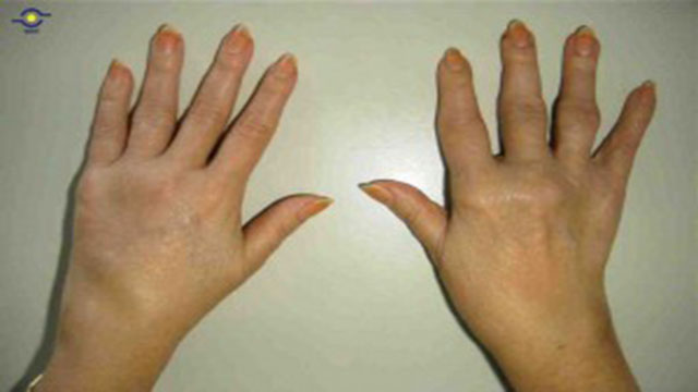 El efecto de la humedad en dolores por artritis